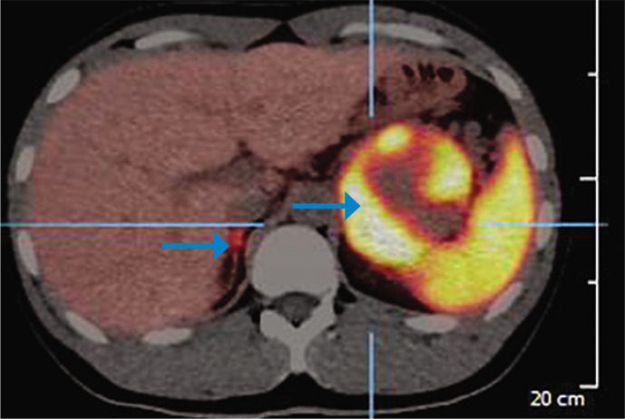 Bilateral Pheochromocytoma with a Novel Pathogenic Variant in the MAX gene: A Case Report.