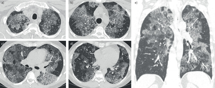 Summary for clinicians: ERS guidelines on pulmonary alveolar proteinosis.