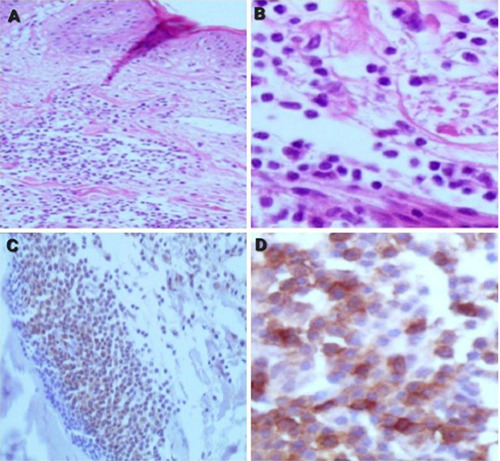 Cutaneous mastocytosis: diagnostic challenges and dietary influences.