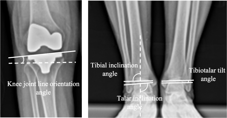 Comparative effects of mechanical and functional alignment in bilateral robotic total knee arthroplasty: a randomized controlled trial.