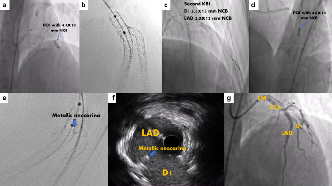 A Novel Modified Mini-Crush Technique for Complex Coronary Bifurcation Lesions: Controlled Balloon-Crush