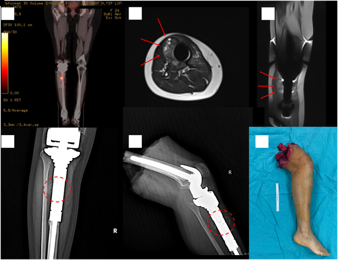 Giant-cell rich osteosarcoma: A report of 3 cases depicting a diagnostic challenge requiring serious attention.