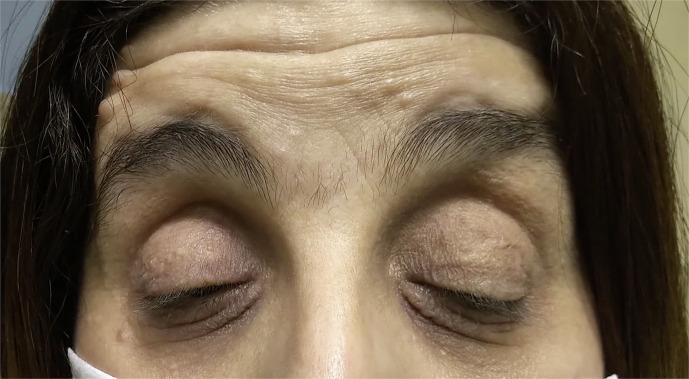 Coexistence of Congenital Aniridia and Ptosis in a Patient with Neurofibromatosis Type I: A Case Report.
