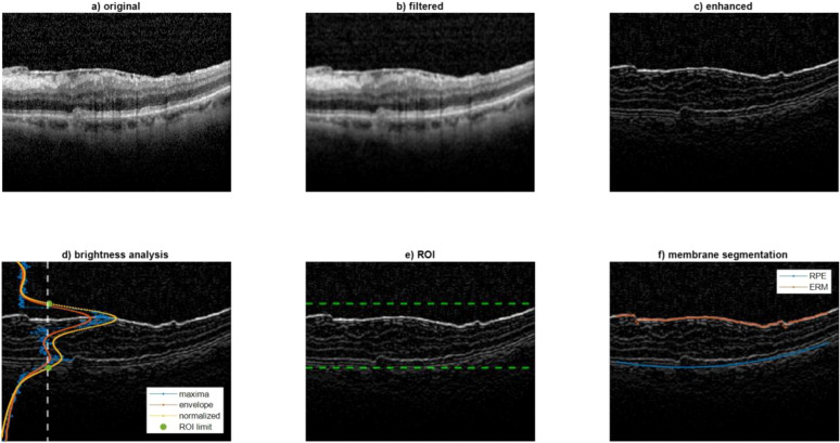 Quantitative analysis of idiopathic epiretinal membrane traction: an updated version of the relaxation index.