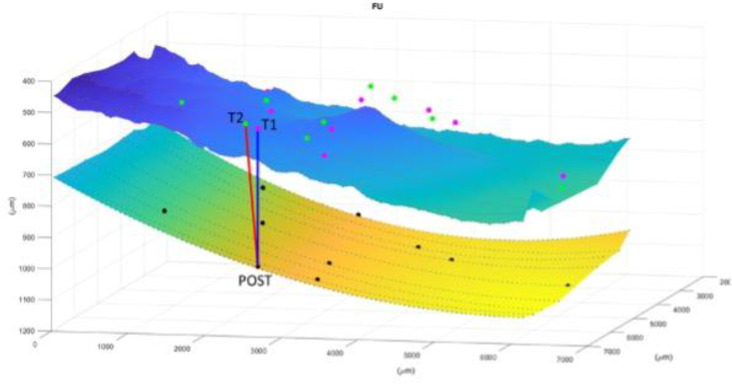 Quantitative analysis of idiopathic epiretinal membrane traction: an updated version of the relaxation index.