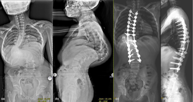 Three-column osteotomy versus Halo-gravity traction combined with posterior column osteotomy in the treatment of dystrophic neurofibromatosis type 1 kyphoscoliosis: a retrospective comparative cohort study.