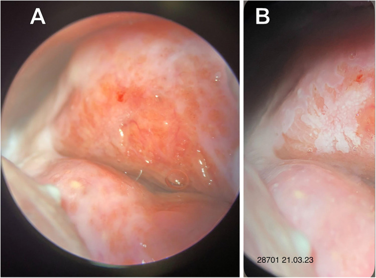 The development of cervical intraepithelial neoplasia in three members of the same family: a case report.