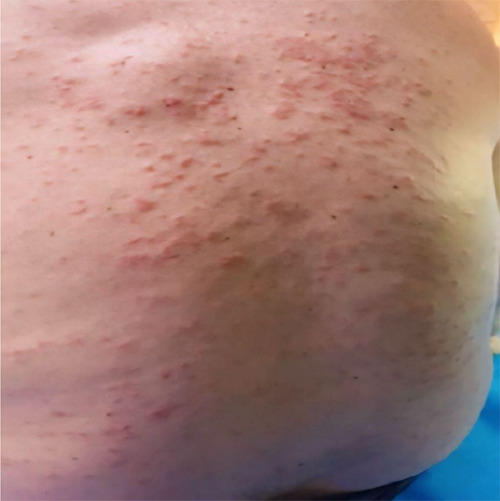 Cutaneous mastocytosis: diagnostic challenges and dietary influences.