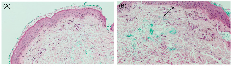 Skin-Colored Papules on the Neck of a Postmenopausal Woman: A Diagnostic Challenge.