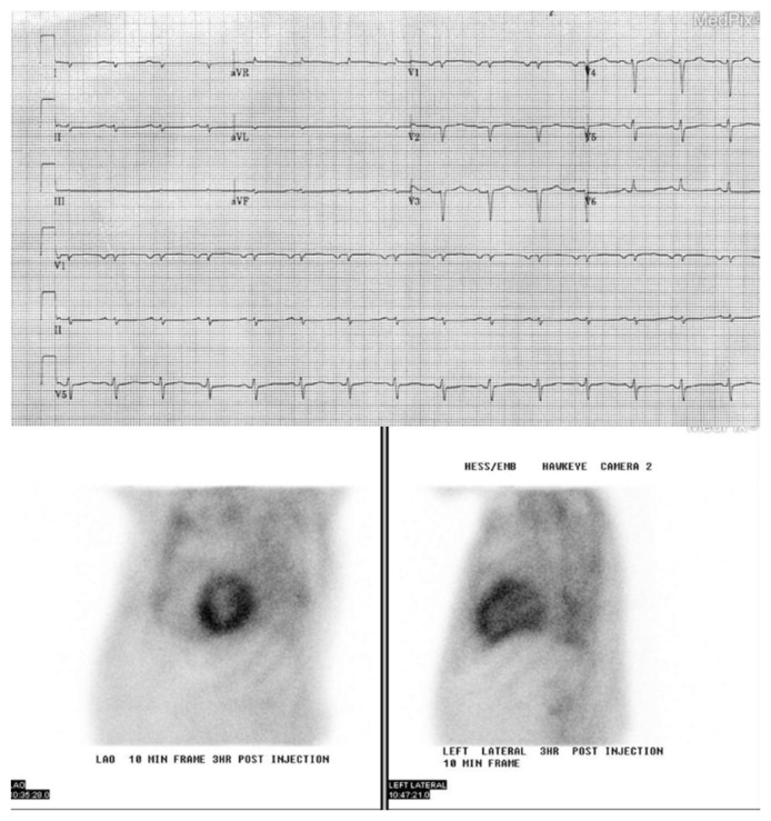 Wild-type Cardiac Amyloidosis due to Transthyretin Protein - A Review.