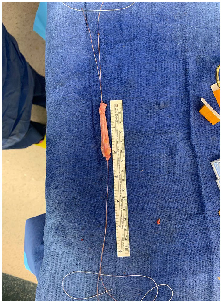 Traumatic Tibialis Anterior Rupture Reconstruction Using Iliotibial Band Autograft.