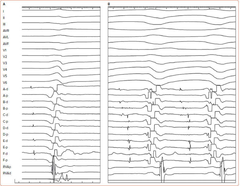 Fascicular and Papillary Muscle Arrhythmias in the Structurally Normal Heart.