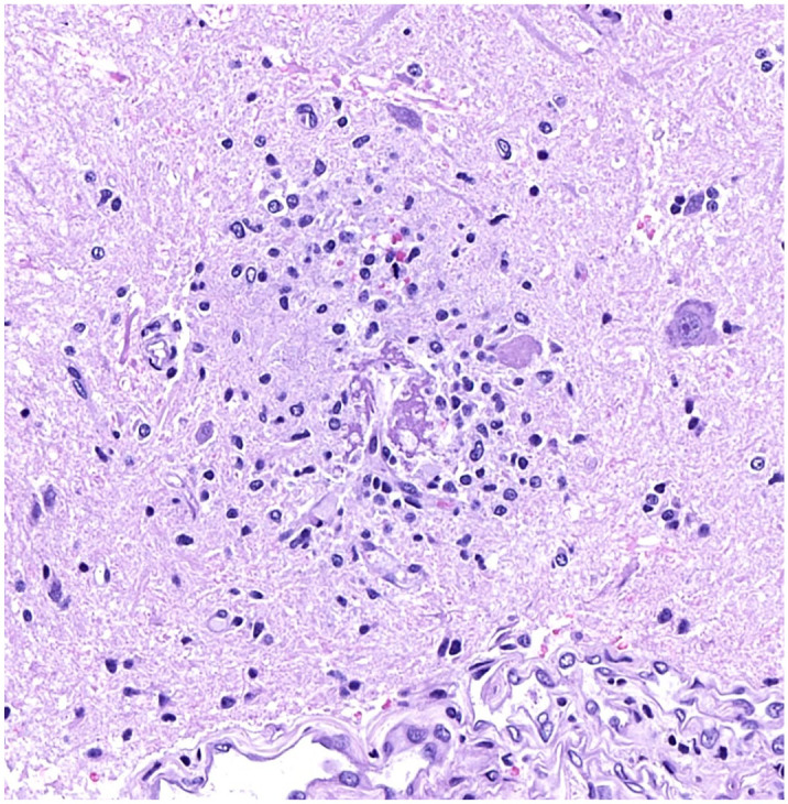 Ring hemorrhages in the central nervous system of severely anemic cynomolgus monkeys.