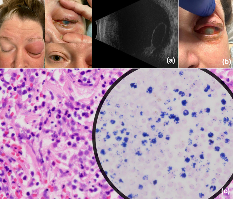 Crystalline lens dislocation as a presenting sign of Streptococcus pyogenes invasive infections.