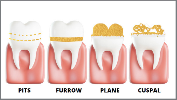 Developmental enamel defects: a must-know for orthodontic practice.