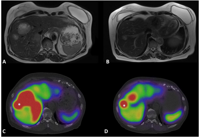 Quantitative 177Lu-DOTATATE SPECT/CT is predictive of 6-month PRRT morphological response in midgut neuroendocrine tumors: a pilot study.