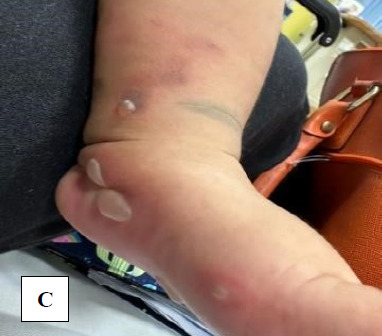 Unforeseen sequela of a traditional remedy: A garlic burn case report.