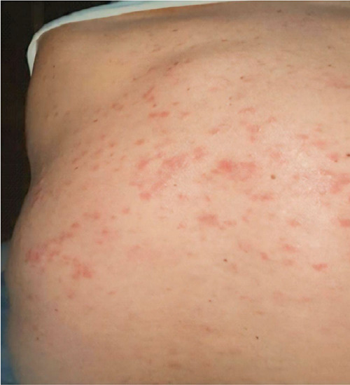 Cutaneous mastocytosis: diagnostic challenges and dietary influences.