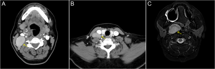 Follicular Dendritic Cell Sarcoma of the Parapharyngeal Space Arising in Association With Castleman Disease.