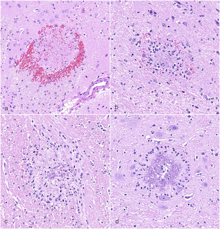 Ring hemorrhages in the central nervous system of severely anemic cynomolgus monkeys.