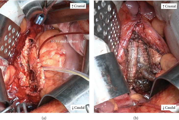 A Surgical Case of an Abdominal Aortic Aneurysm With a Meandering Inferior Mesenteric Artery due to Superior Mesenteric Artery Occlusion.