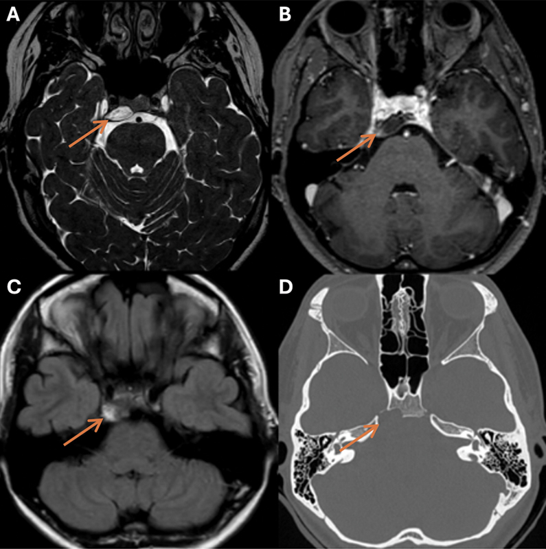 Spontaneous Shrinking and Growing Skull Base Chordoma.