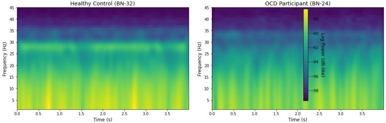 Classifying Obsessive-Compulsive Disorder from Resting-State EEG using Convolutional Neural Networks: A Pilot Study.