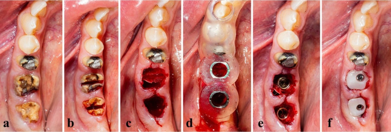 Early versus conventional loading for fully guided immediate implant placement in molar sites: a randomized controlled clinical study.