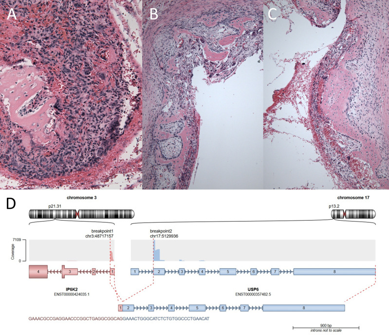 Novel and unusual <i>USP6</i> fusion partners in aneurysmal bone cyst and their role in pathogenesis and histopathological evaluation of this disease.