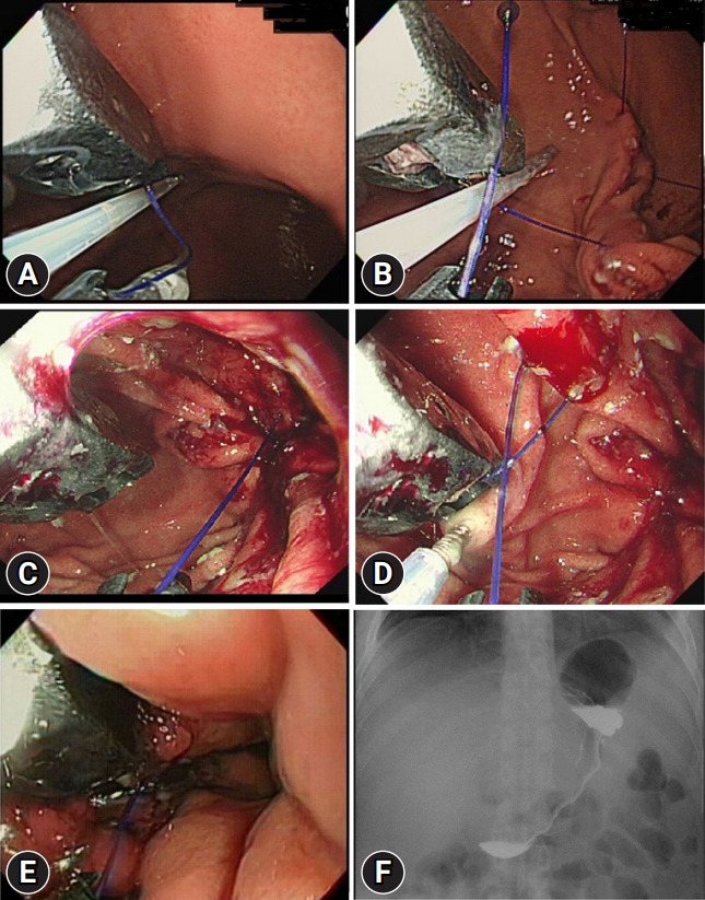 Endoscopic sleeve gastroplasty combined with anti-obesity medication for better control of weight and diabetes.