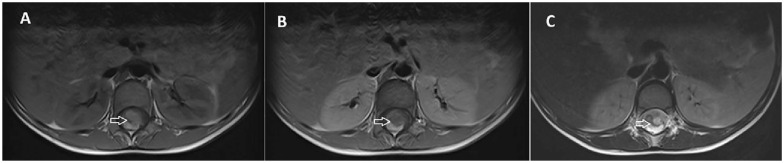 Intradural-Intramedullary Spinal Teratoma with Syrinx Formation: A Case Report.