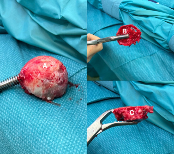 Surgical procedure and retrospective comparative series of Microport's AnteriorPath<sup>®</sup> vs. AMIS<sup>®</sup> in total hip arthroplasty. Preliminary findings from a single institution.