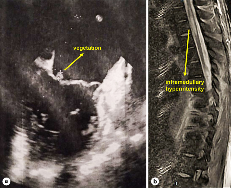 Keratitis, Ichthyosis, and Deafness Syndrome with Endocarditis and Myelitis: A Rare Case Report.