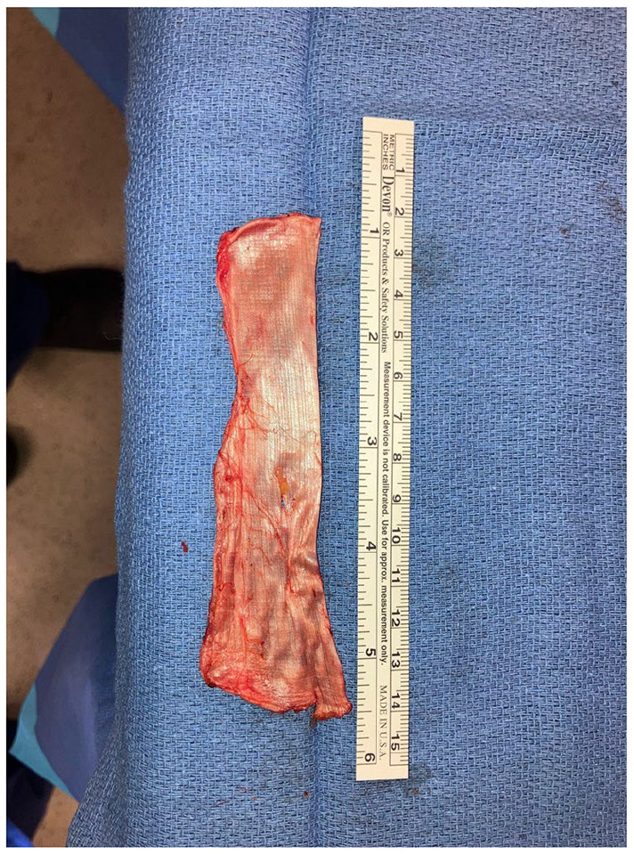 Traumatic Tibialis Anterior Rupture Reconstruction Using Iliotibial Band Autograft.
