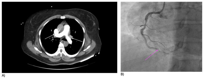 Inferior Wall STEMI in a Young Patient-A Sequela of Phentermine and Smoking.