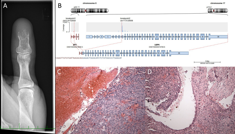 Novel and unusual <i>USP6</i> fusion partners in aneurysmal bone cyst and their role in pathogenesis and histopathological evaluation of this disease.