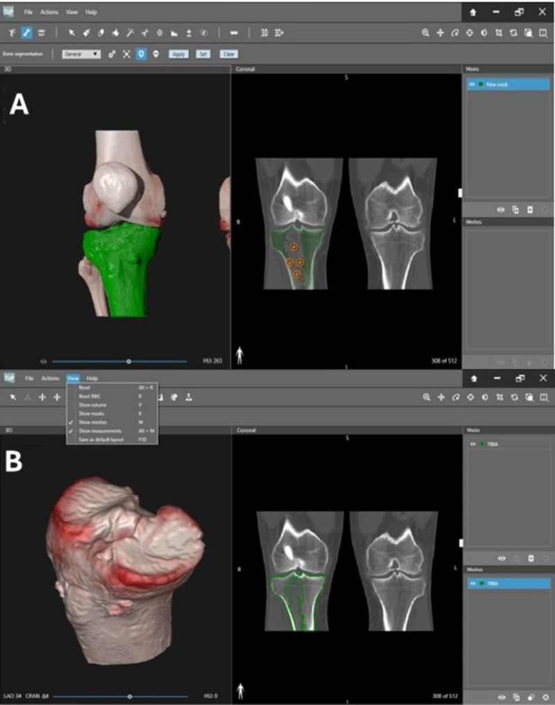 Patient-specific 3D tibial model: transforming meniscal allograft transplantation and surgical planning.