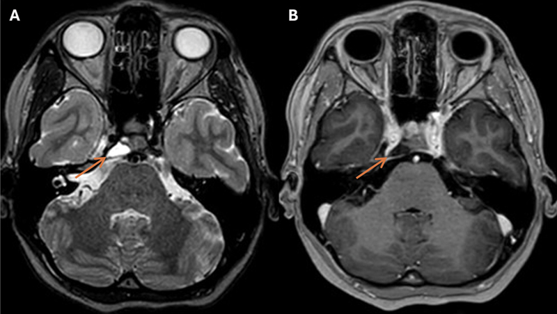 Spontaneous Shrinking and Growing Skull Base Chordoma.