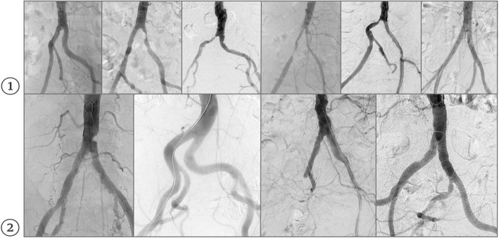 Accuracy of segment anything model for classification of vascular stenosis in digital subtraction angiography.