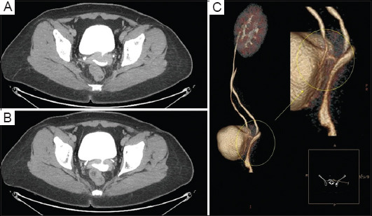 Omental wrap for salvaging bladder repair: A novel approach.