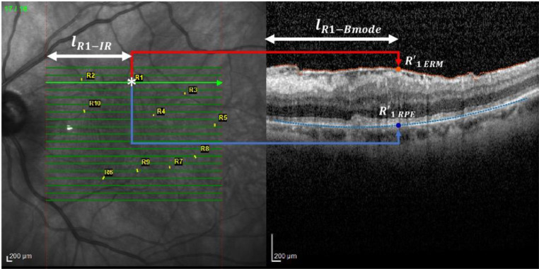 Quantitative analysis of idiopathic epiretinal membrane traction: an updated version of the relaxation index.
