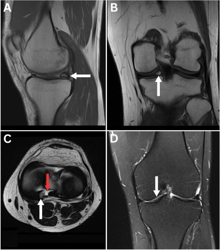 Meniscal Ossicle.