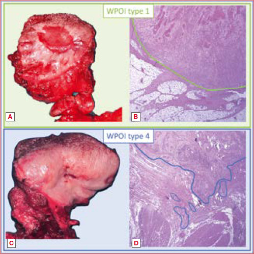 Impact of surgical margins status on survival outcomes in oral cavity squamous cell carcinoma: a systematic review and meta-analysis.