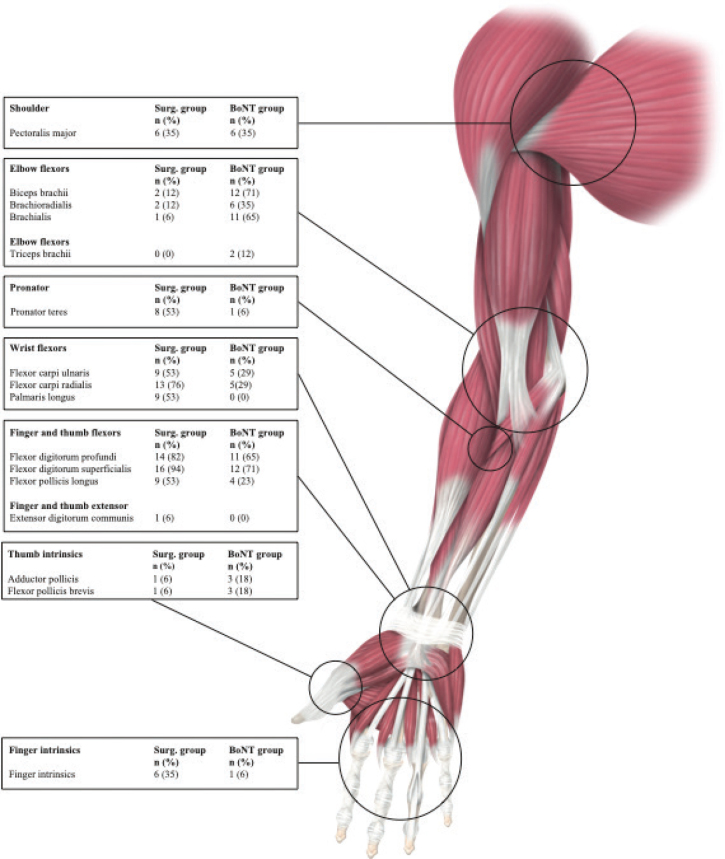 LONG-TERM EFFICACY OF SPASTICITY-CORRECTIVE SURGERY AND BOTULINUM TOXIN INJECTIONS FOR UPPER LIMB SPASTICITY TREATMENT.