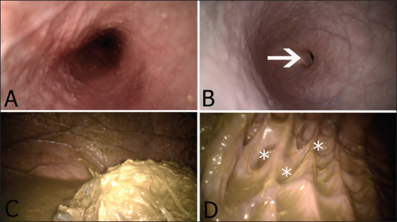 Ruminoscopy in apparently healthy camel calves (<i>camelus dromedarius</i>): A technique description and ruminoscopic observations.