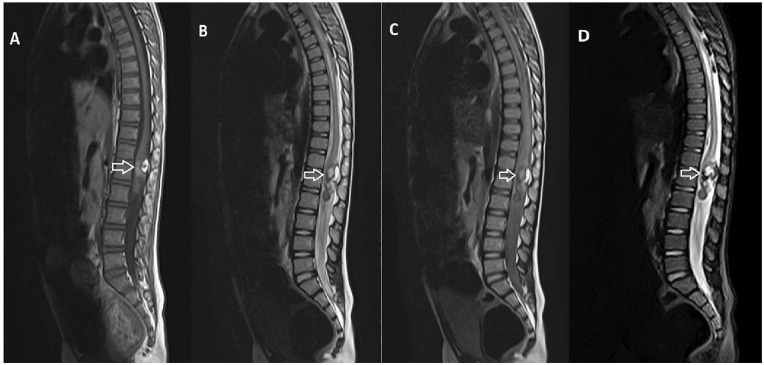 Intradural-Intramedullary Spinal Teratoma with Syrinx Formation: A Case Report.