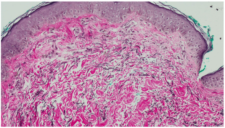 Skin-Colored Papules on the Neck of a Postmenopausal Woman: A Diagnostic Challenge.