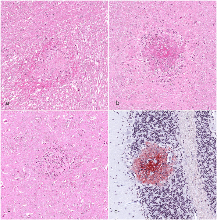 Ring hemorrhages in the central nervous system of severely anemic cynomolgus monkeys.