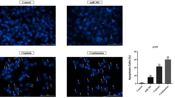 Synergistic Effect of miR-383 and Cisplatin on Inhibition of Growth, Proliferation, and Migration of Lung Cancer Cells.