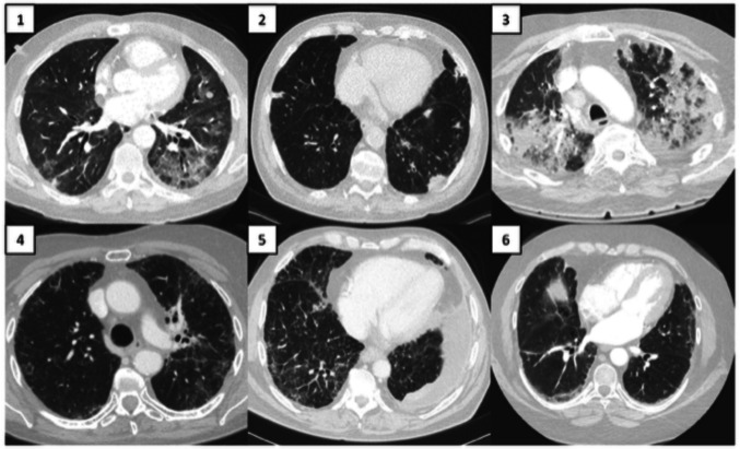 Clinical characteristics, outcomes, and predictive modeling of patients diagnosed with immune checkpoint inhibitor therapy-related pneumonitis.